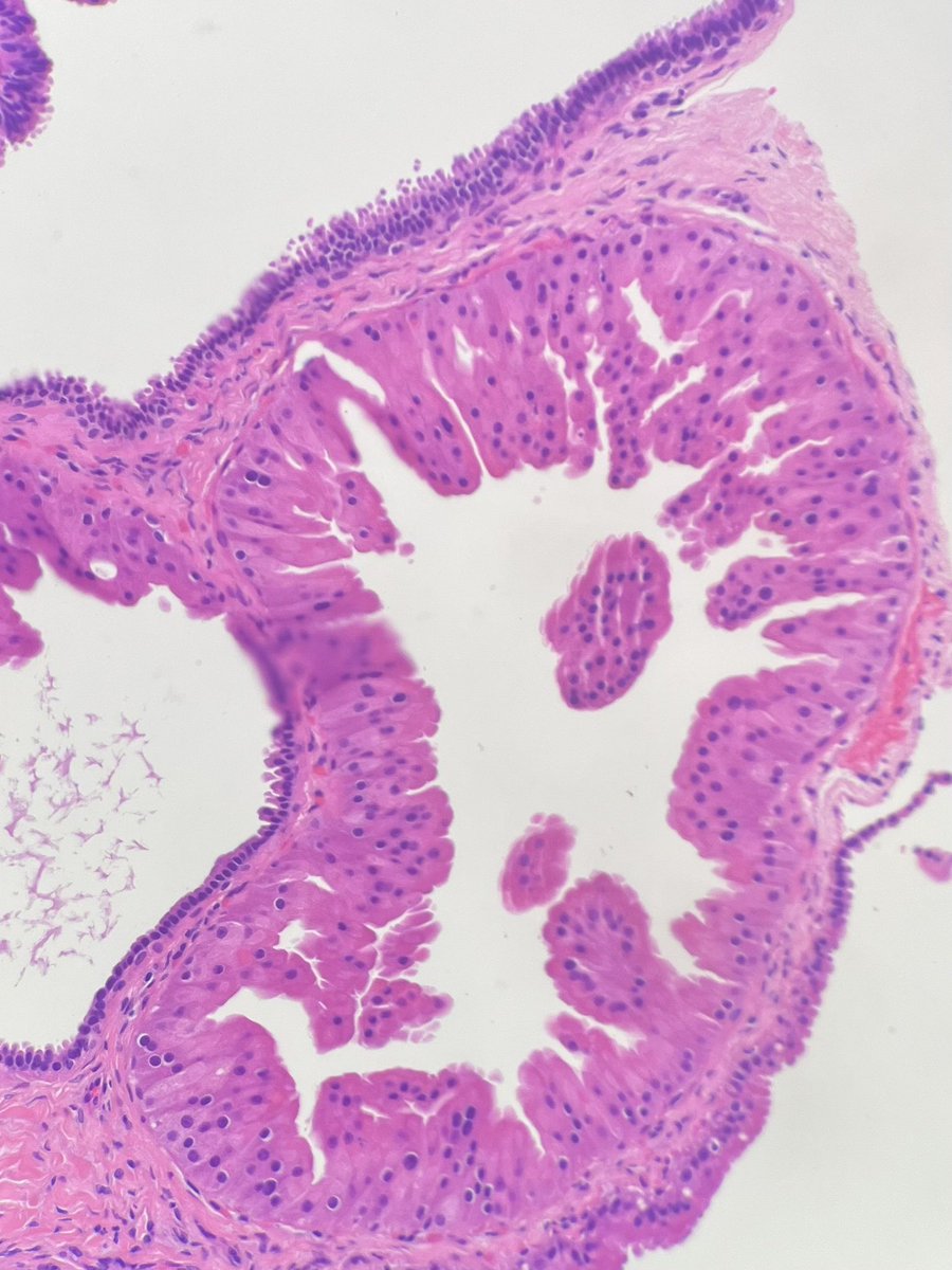 What’s Neu?
#breastpath service is tough, so there’s a lot to learn. A beginner guide to breast pathology 🧵

Be triple positive, not triple negative!  Begin quiz💡
#Her2 #pathX #PathTwitter #pathquiz