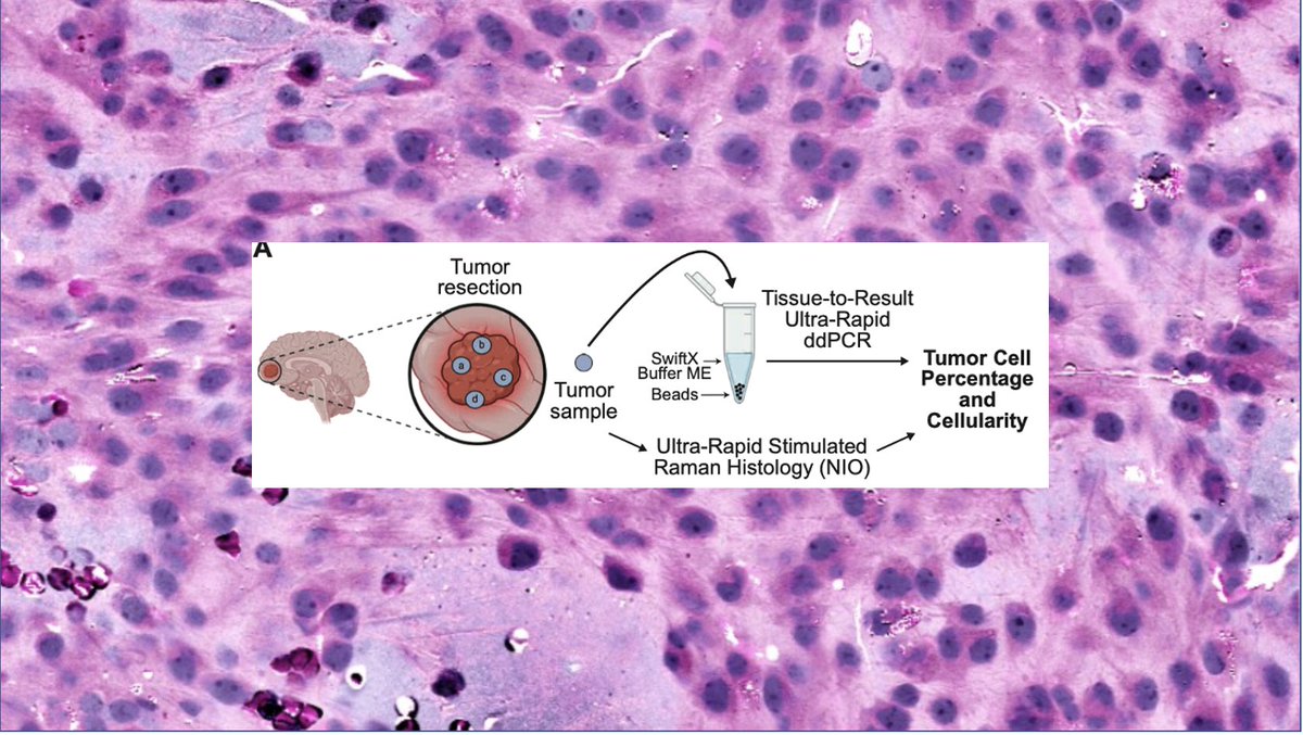 The time is now for a new standard in #glioma surgery: molecularly complete resection! Honored to have worked on this project with @giladevrony and his brilliant students! @nyugrossman @Perlmutter_CC @nyulangone