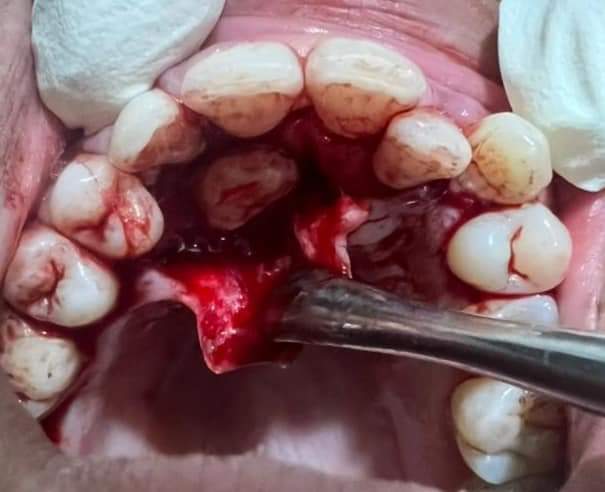mostafa511997's tweet photo. Surgical removal of palatally impacted canine 🙏♥️ https://t.co/aFlbps8SWs
