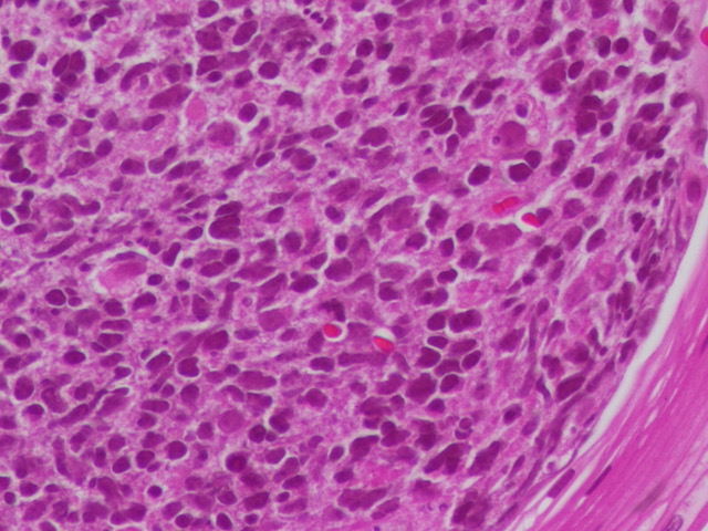 Celina Stayerman MD (@ariella8) on Twitter photo #GIPath #Pedipath #Hemepath
Child with nausea, abdominal pain
bx from the esophagus showing this isolated finding
I still can not let this go 😅
What is the relevance of this isolated finding
What would you say in the report, if you said 🤔
<a href="/hematogones/">Chandra Krishnan, MD</a> <a href="/stephen_lagana/">stephen lagana</a> #GIPath #Pedipath #Hemepath
Child with nausea, abdominal pain
bx from the esophagus showing this isolated finding
I still can not let this go 😅
What is the relevance of this isolated finding
What would you say in the report, if you said 🤔
<a href="/hematogones/">Chandra Krishnan, MD</a> <a href="/stephen_lagana/">stephen lagana</a>