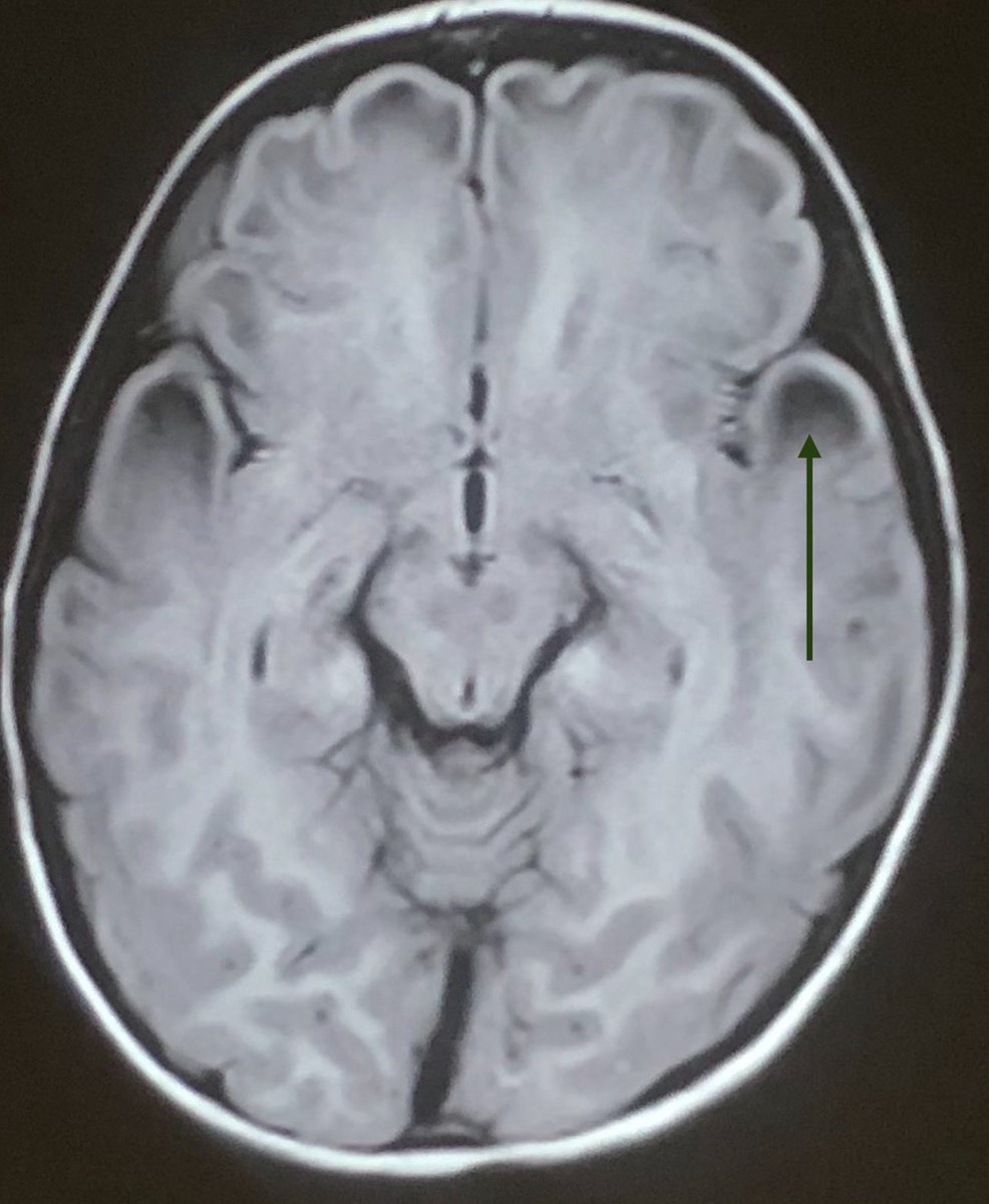 Tip of the day 💡: Megalencephalic Leukodystrophy-First described on an Indian cohort by Singhal et al in 1991- referred to as the “Agrawal Gene”. Subcortical cysts and intramyelinic edema are strong features! This weekend, discover new vistas.