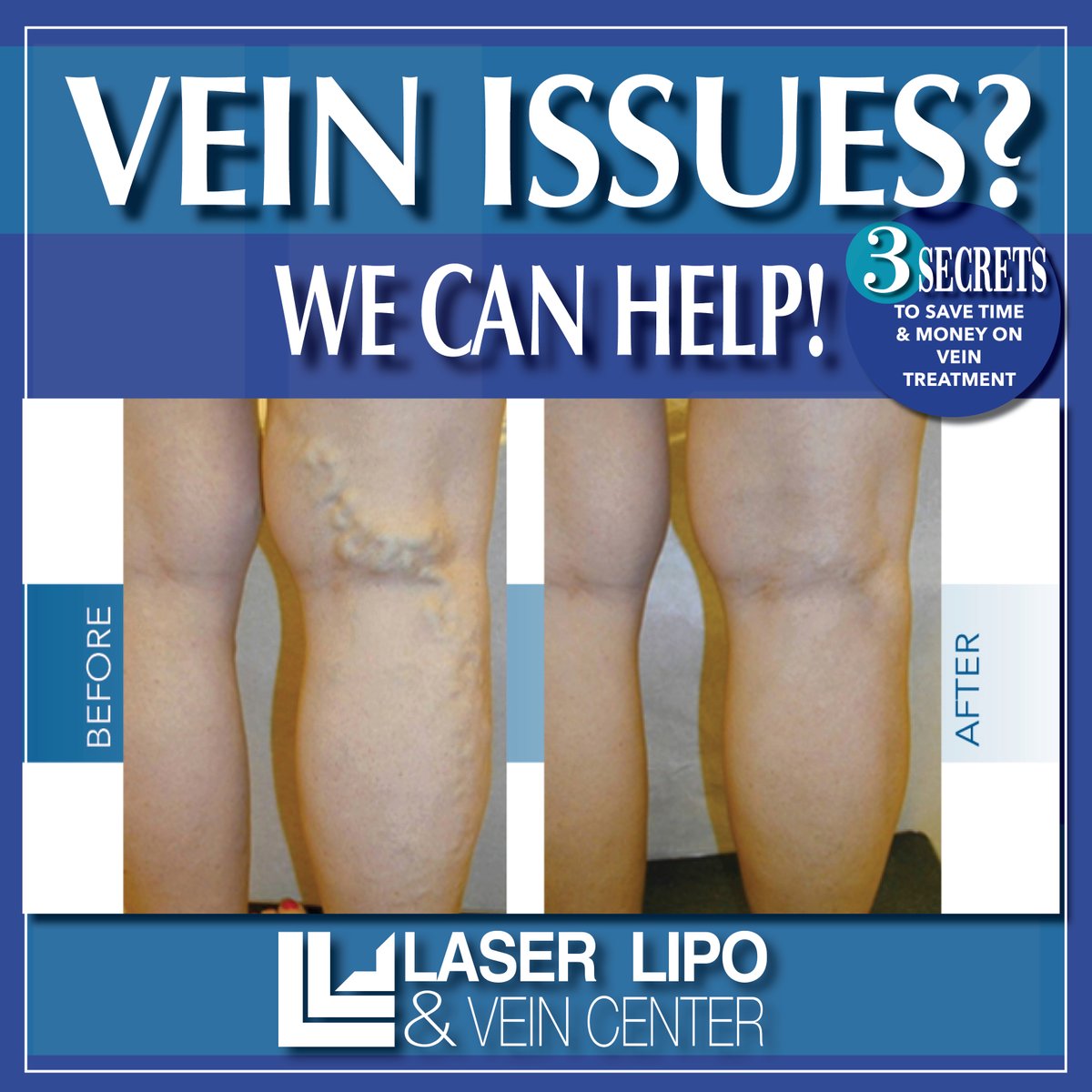 Don't let vein issues put a damper on your summer plans! ☀️
If you're tired of dealing with leg discomfort or swelling, it's time to take action. Call us at 636-614-1665 to schedule your consultation and start feeling better for summer!

#VeinTreatments #VeinDisease #LLVC