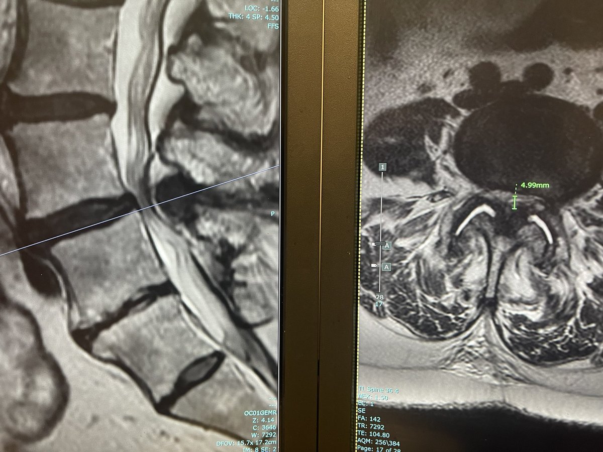 Another good #MSKIR case in a woman in her 60s with severe central canal stenosis due to ligamentum flavum hypertrophy, bad facets, and severe sclerosis between the spinous processes consistent with #Baastrup syndrome. 

#InSpan from @KICVentures

🧵…