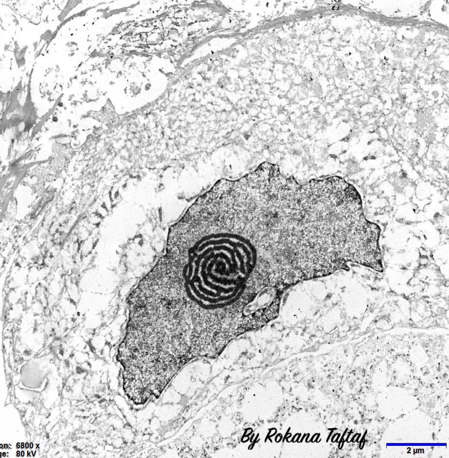 I was fascinated when I came across this maze-like large nucleolus in a tumor cell, as revealed by Electron Microscopy! It’s an impressive blend of neatness and complexity!!
#Pathology #PathTwitter #PathX