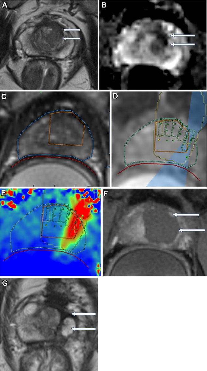 In an article published in Radiology, <a href="/SangeetGhai/">Sangeet Ghai</a>, Toronto General Hospital, Ontario, &amp; colleagues examined the use of MRI-guided FT for accurate targeting of localized clinically significant prostate cancer while preserving healthy prostate tissue. bit.ly/4aW9TXT