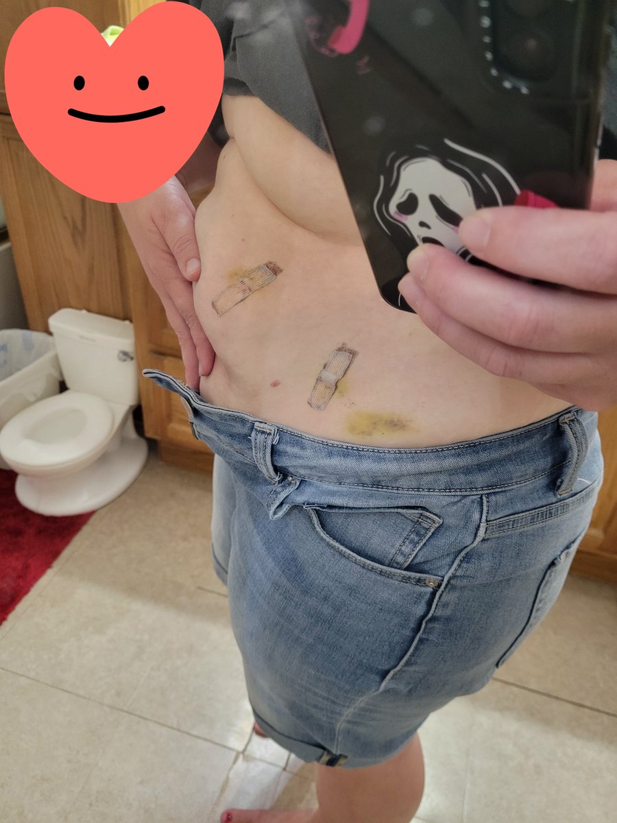 DawnP2002's tweet photo. I had surgery a week ago and also lost 5 pounds.. go me!! #surgery #incisions https://t.co/BYuYZ8jeyN