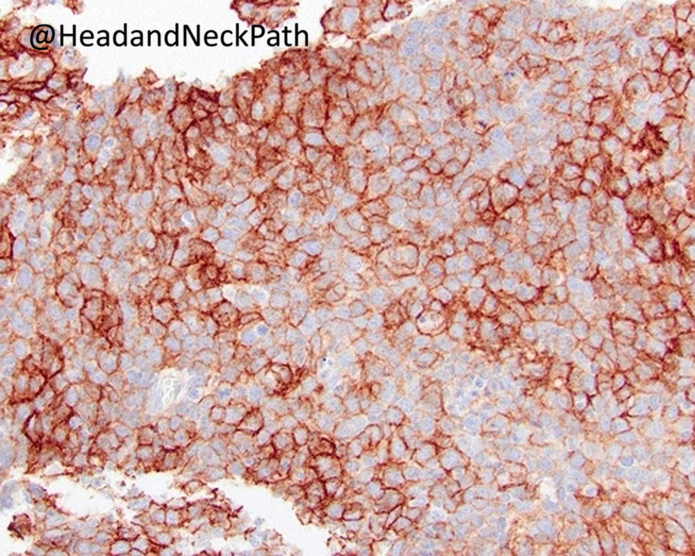 HeadandNeckPath's tweet photo. Top IHC/ISH Hacks for and Molecular Surrogates of Poorly Differentiated Sinonasal Small Round Cell Tumors
Diana Bell
https://t.co/iryBKfNbEq
#HeadNeckPathol #HNPJ #HeadandNeckPath #Pathology #ENTPath #PathologyTweet https://t.co/gr9WafJ49A