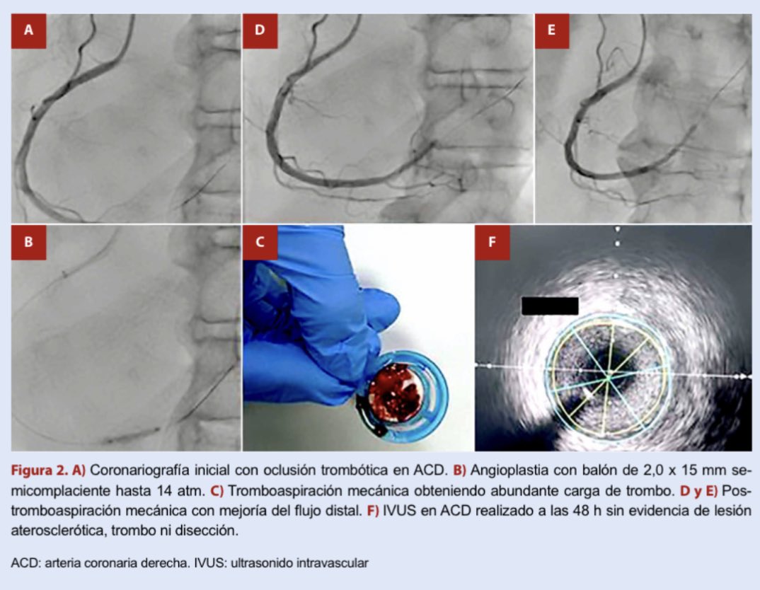 🤔Abordaje del SICA por embolia coronaria

📌Causas y Criterios diagnósticos
📌Imagen intracoronaria: usos e importancia para el manejo 
📌Pronóstico.

Léelo aquí: 
👇🏼
doi.org/10.47487/apcyc…