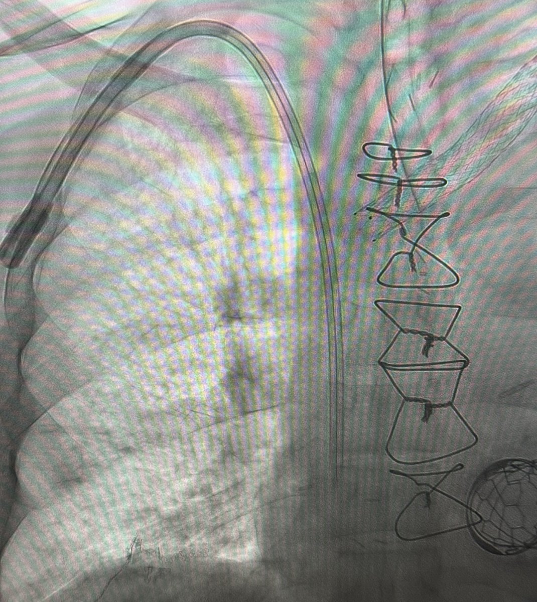 Ahmed Kamel MD, PhD, FSIR (@ahmed_kamel_ir) on Twitter photo A case of Surfacer device used for a patient with limited access and occluded IJV needing tunneled dialysis line (permcath). <a href="/UTHouston_IR/">UT Houston_IR</a>
#InterventionalRadiology #MinimallyInvasiveProcedures #Dialysis #TunnelCatheter #ResidentTraining #GlobalEducation #SharpRecanalization A case of Surfacer device used for a patient with limited access and occluded IJV needing tunneled dialysis line (permcath). <a href="/UTHouston_IR/">UT Houston_IR</a>
#InterventionalRadiology #MinimallyInvasiveProcedures #Dialysis #TunnelCatheter #ResidentTraining #GlobalEducation #SharpRecanalization