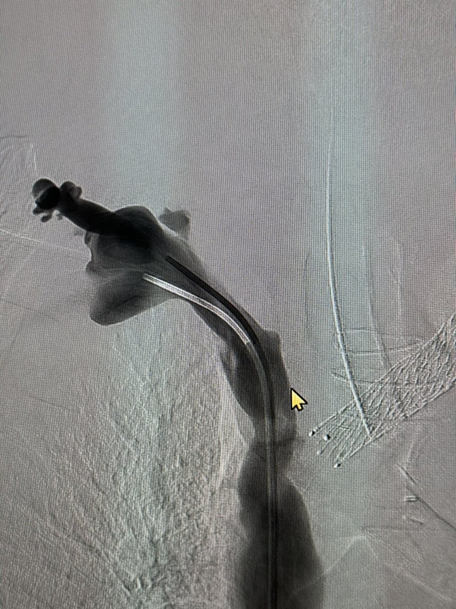ahmed_kamel_ir's tweet photo. A case of Surfacer device used for a patient with limited access and occluded IJV needing tunneled dialysis line (permcath). @UTHouston_IR
#InterventionalRadiology #MinimallyInvasiveProcedures #Dialysis #TunnelCatheter #ResidentTraining #GlobalEducation #SharpRecanalization https://t.co/hTKbhg1IKK