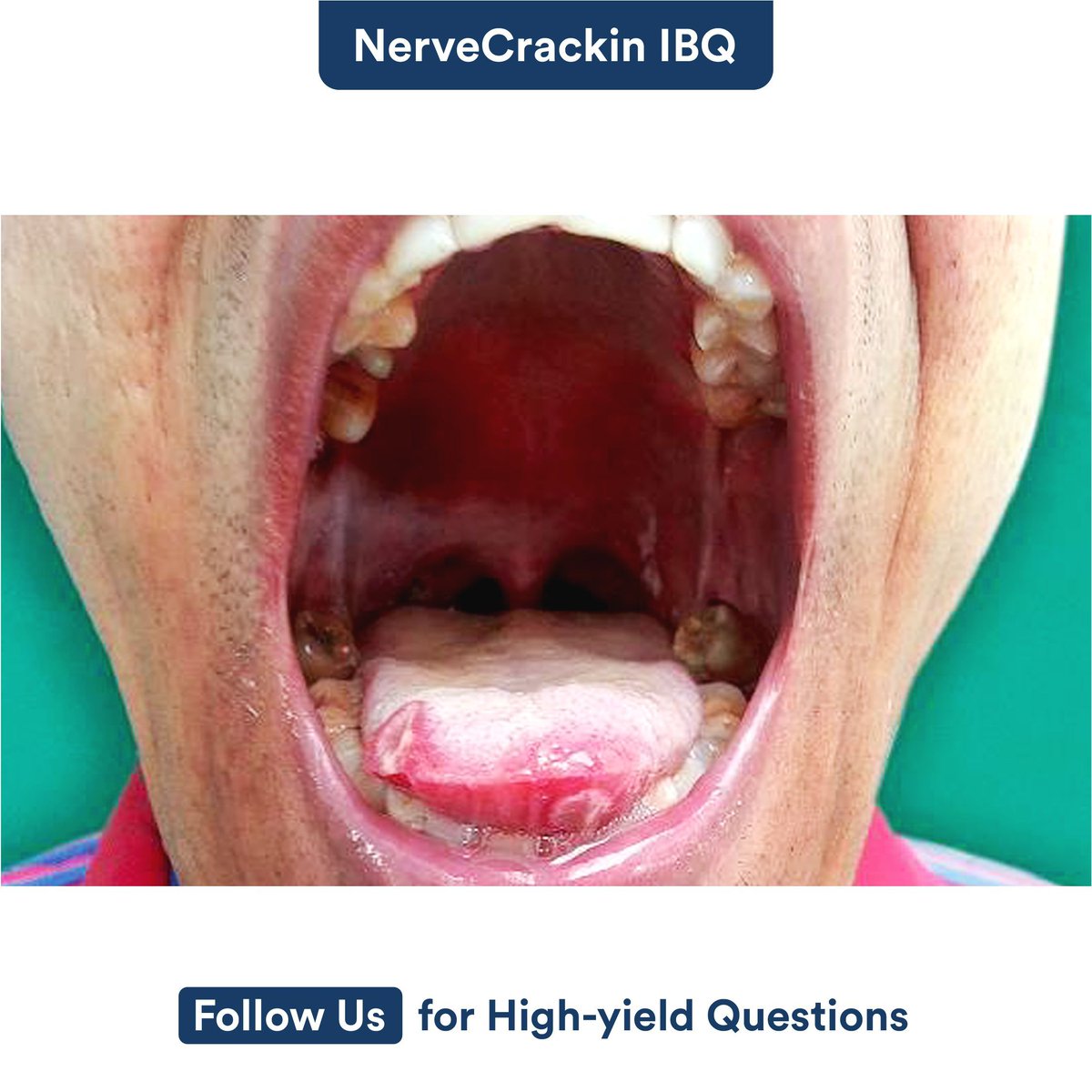 Which of the following conditions is commonly associated with the oral ulceration depicted in the image?

A) Aphthous stomatitis 
B) Oral candidiasis
C) Herpes simplex virus infection
D) Behçet’s disease

#DigiNerve #IBQ #NerveCrackin #QuizTime #MedicalStudents #disease #oral