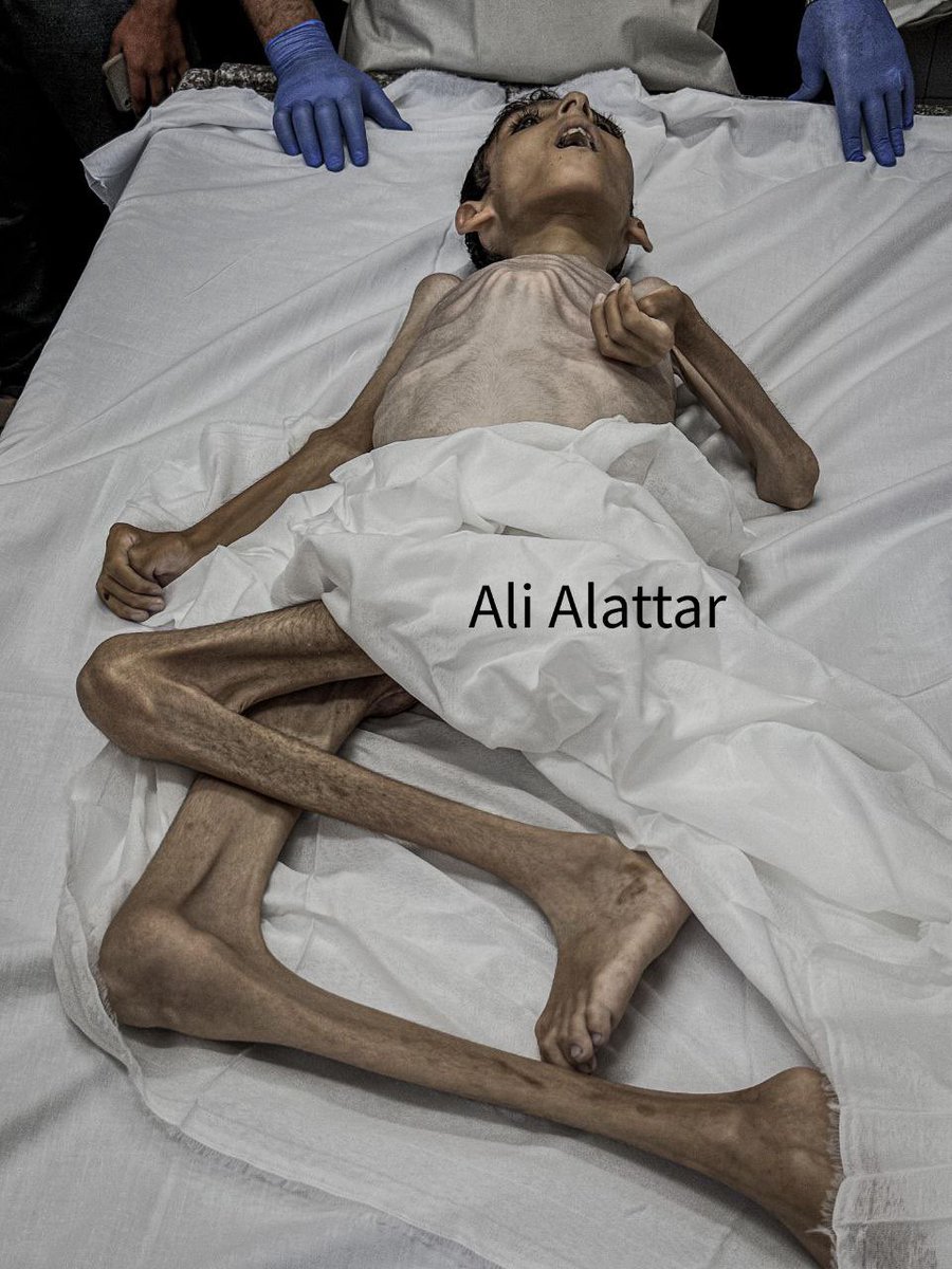 Breaking: The child Abdul Qader Al-Sarahi (13 years old) passed away at Al-Aqsa Hospital in Deir Al-Balah, central Gaza, due to Israeli-imposed starvation, malnutrition, and the lack of available treatment amid Israel's occupation of the Rafah crossing.