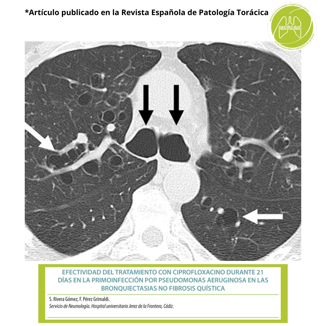 EFECTIVIDAD DEL TRATAMIENTO CON CIPROFLOXACINO DURANTE 21 DÍAS EN LA PRIMOINFECCIÓN POR PSEUDOMONAS AERUGINOSA EN LAS BRONQUIECTASIAS NO FIBROSIS QUÍSTICA
rev-esp-patol-torac.com/files/publicac…
#revistaespañoladepatologíatorácica #neumologia #CirugiaToracica #bronquiectasias #fibrosisquística