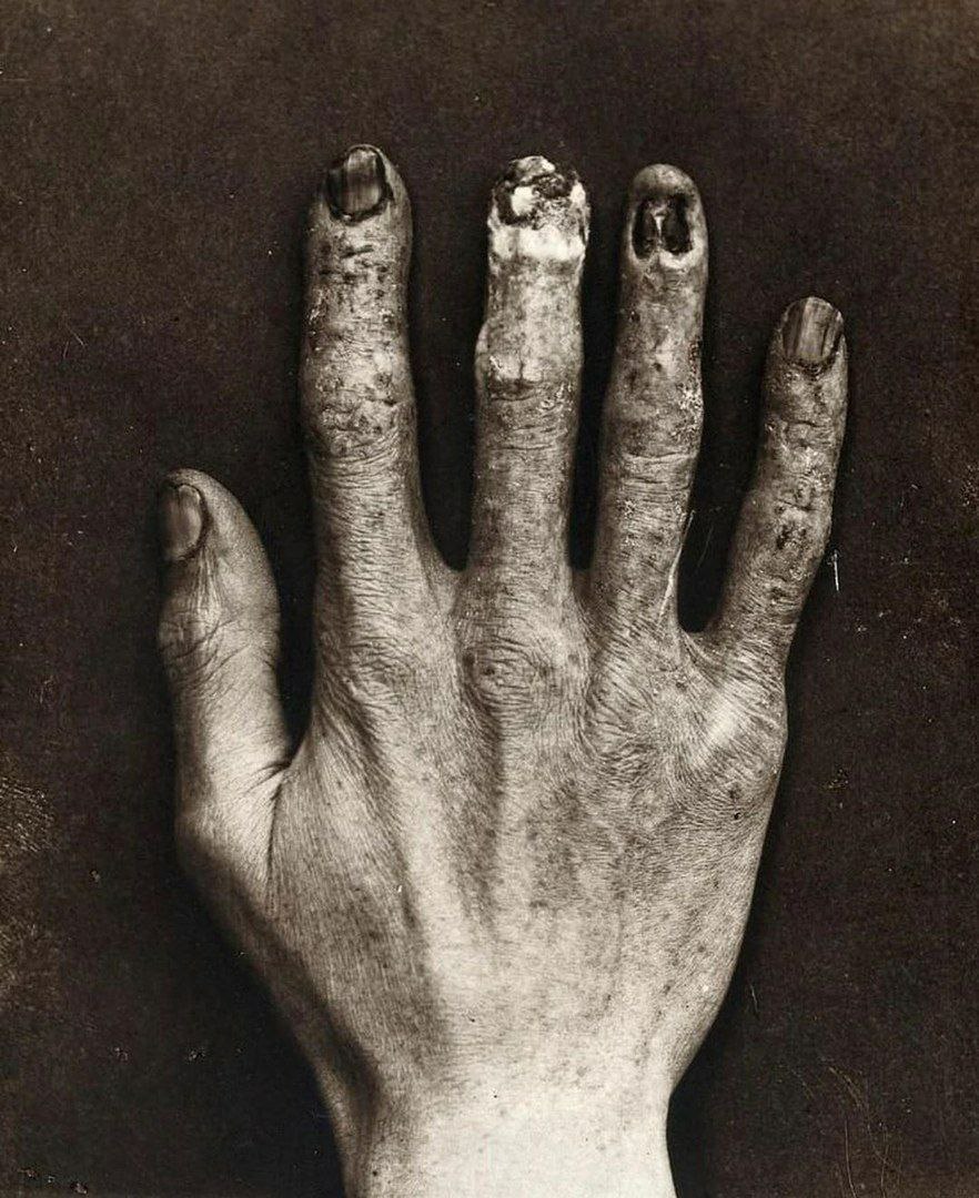 Radiologist hand , damage caused by exposure to radiation, 1900.