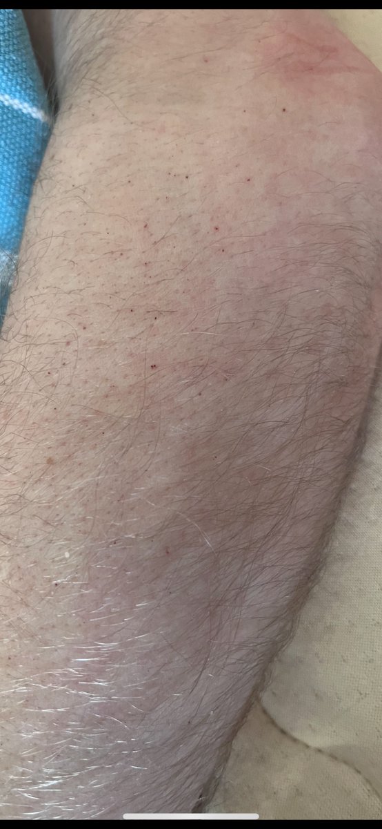 I have thousands (!) of visible pinprick sized chronic petechiae like eruptions all over my body. One would think that is worth investigating, but, it's seemingly impossible to find someone who is interested. #MECFS