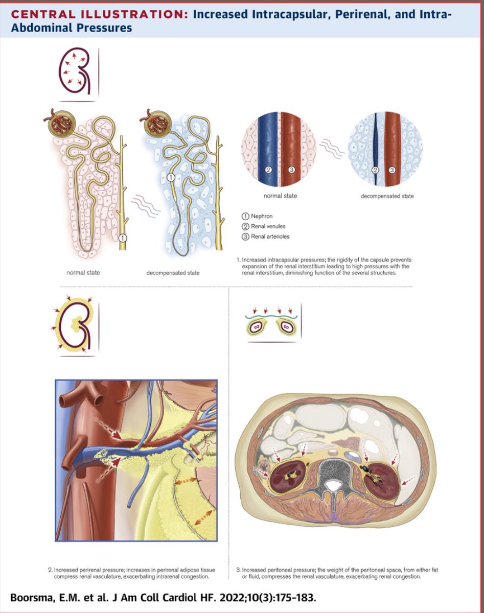 Renal Compression in Heart Failure: The Renal Tamponade Hypothesis The rigidness of the renal capsule is central in congestion-induced damage to the renal structures Renal decapsulation has been shown to be beneficial in animals jacc.org/doi/10.1016/j.… @SJGreene_md