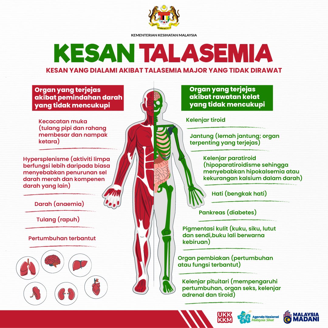 KKMPutrajaya's tweet photo. Talasemia adalah kumpulan penyakit yang menghalang badan daripada menghasilkan jumlah darah 🩸 yang mencukupi dan berkualiti. Keadaan ini disebabkan oleh perubahan terhadap gen 🧬 yang mengawal penghasilan hemoglobin. Hemoglobin adalah protein dalam sel darah merah yang membawa oksigen ke seluruh badan. Perubahan kepada hemoglobin boleh menyebabkan kekurangan darah yang teruk.

Badan manusia bergantung kepada tahap hemoglobin yang berfungsi dengan baik.

‼️Jika tidak dirawat, pesakit talasemia boleh membawa maut yang disebabkan oleh kesan anemia yang serius, kegagalan jantung dan jangkitan kuman.