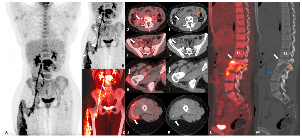 OruUct's tweet photo. Interesting #Diagnostic Image: Tuberculous Spondylodiscitis with Psoas Abscess Descending
into the Anterior Femoral Compartment on PET-CT. A glimpse into the #PhD project of
@JulianScherer10 investigating PET-CT for #spinaltuberculosis @UCT_Research
https://t.co/AGoYmh875e https://t.co/tnbEP0P5P8