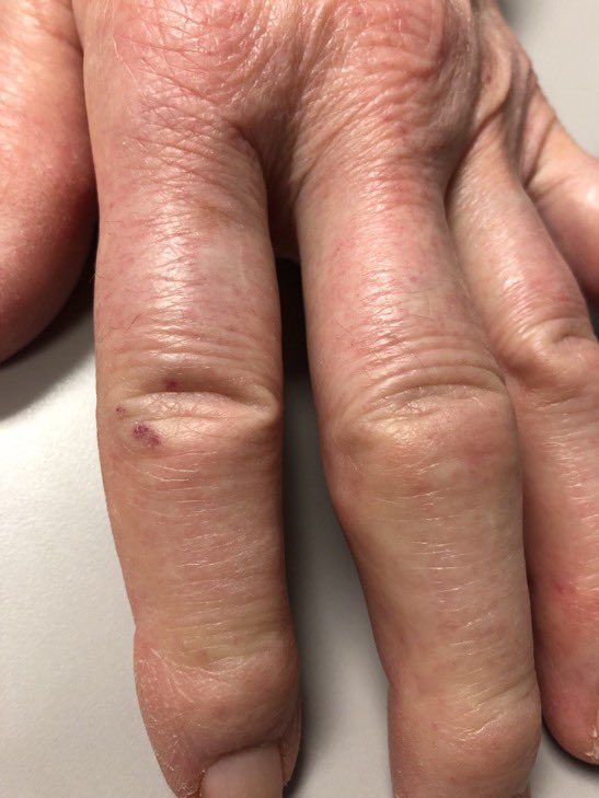 A patient with Raynauds, GERD and dysphagia presented with these findings. What is the likely diagnosis? H/t @Janetbirdope #medEd