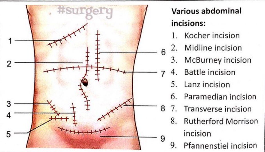 Types of incisions