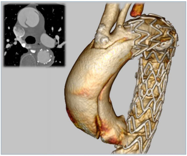 #Endovascular #AcuteAorticSyndromes
✨Dr. Enrico Rinaldi delved into the acute aortic syndromes.
📍aTBAD, IMH, PAU, bTAI, rDTA
Endovascular treatment- a safer option for high-risk patients
🌈More information oaepublish.com/articles/2574-…