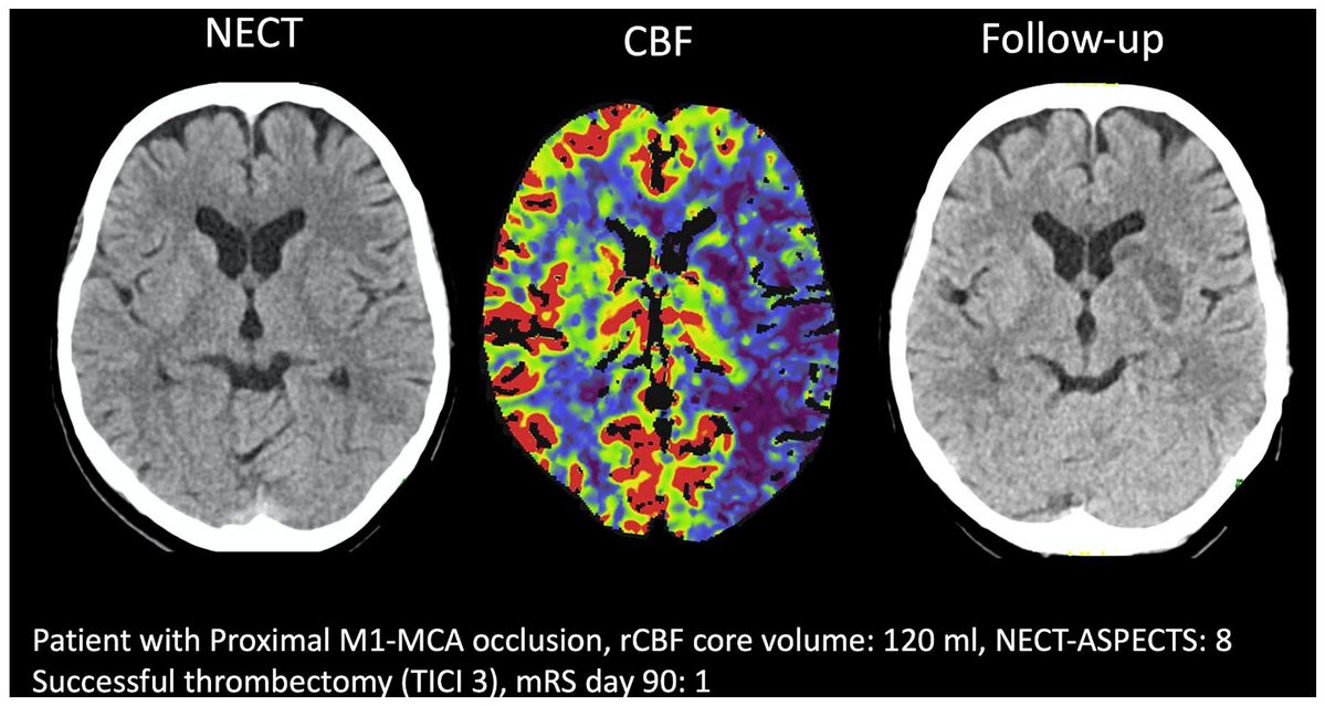 International Journal of Stroke (@intjstroke) on Twitter photo #FlashbackFriday !
🩸💉In patients with ASPECTS ≥6, core volume did not modify outcomes after recanalization
🧠Reperfusion & ⬆️core volume were associated with core overestimation
journals.sagepub.com/doi/full/10.11… <a href="/BroocksGabriel/">Gabriel Broocks</a> #FlashbackFriday !
🩸💉In patients with ASPECTS ≥6, core volume did not modify outcomes after recanalization
🧠Reperfusion & ⬆️core volume were associated with core overestimation
journals.sagepub.com/doi/full/10.11… <a href="/BroocksGabriel/">Gabriel Broocks</a>