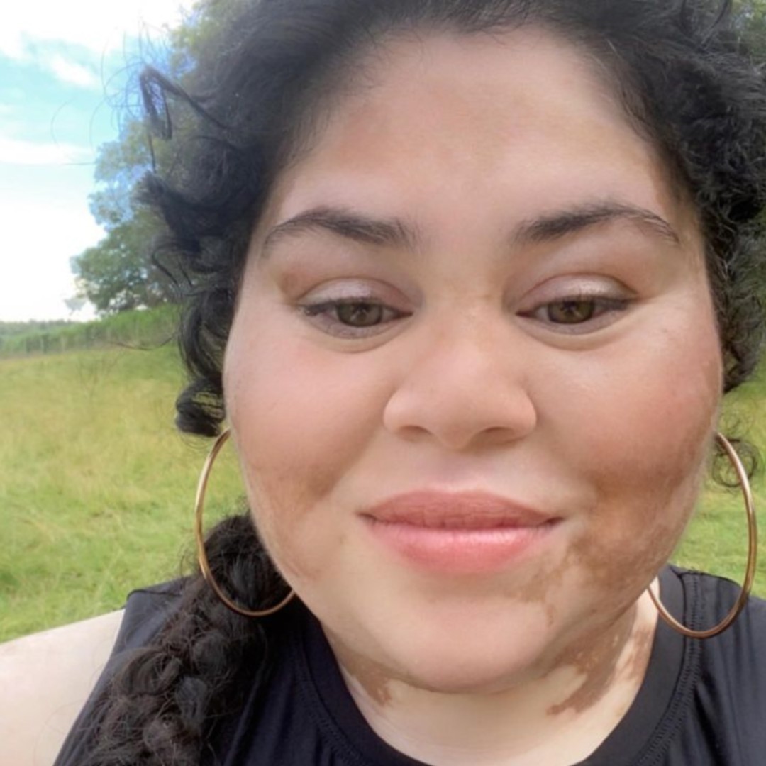 'Developing vitiligo at age 14 was tough. It’s an age where teenagers become more aware of their body image and feel more anxious about its changes and development. Adding vitiligo to the mix was extremely difficult.' Read Angela's full story ➡️ bit.ly/44LGfCp