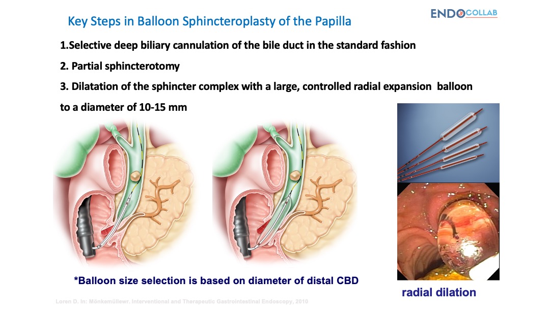 Key Steps in Balloon Sphincteroplasty of the Papilla

1. Selective deep biliary cannulation of the bile duct in the standard fashion
2. Partial sphincterotomy
3. Dilatation of the sphincter complex with a large, controlled radial expansion balloon to a diameter of 10-15 mm