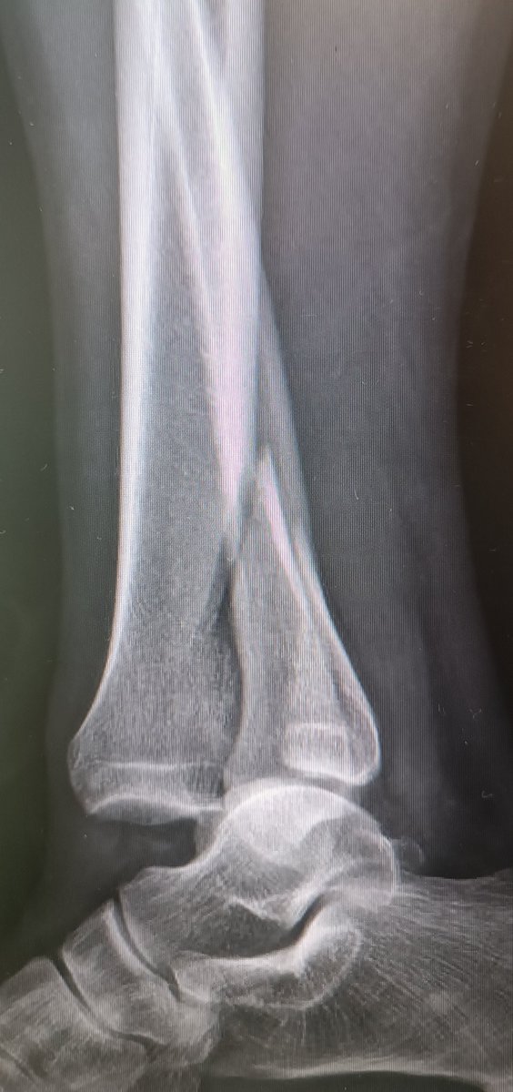 One of the things I like about tibial pilon fractures is it variability and diferents ways  of fixation @orthotwitter