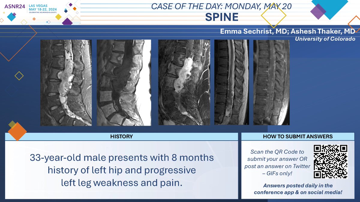 The American Society of Neuroradiology (@theasnr) on Twitter photo #ASNR24 #COTD: Monday Spine
Thx to Drs. Emma Sechrist and Ashesh Thaker
<a href="/EmmaSechrist/">Emma Sechrist</a> <a href="/AsheshThaker/">Ashesh Thaker</a>
NO SPOILERS!!! Give answers as GIFs ONLY.
Submit answers for a chance to win prizes! Answer tomorrow morning.
#ASNR24 #Neuroradiology #FOAMed #RadRes #MedEd #ASNR24 #COTD: Monday Spine
Thx to Drs. Emma Sechrist and Ashesh Thaker
<a href="/EmmaSechrist/">Emma Sechrist</a> <a href="/AsheshThaker/">Ashesh Thaker</a>
NO SPOILERS!!! Give answers as GIFs ONLY.
Submit answers for a chance to win prizes! Answer tomorrow morning.
#ASNR24 #Neuroradiology #FOAMed #RadRes #MedEd