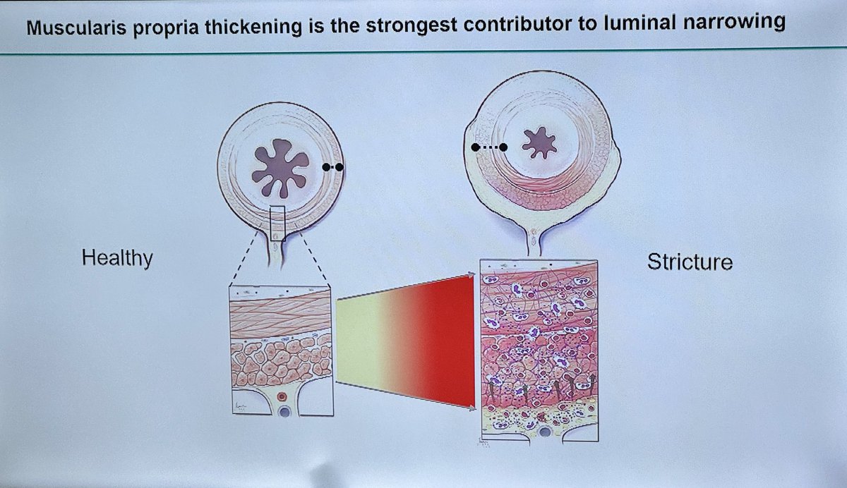 HolubarStefan's tweet photo. Wait a minute, what?!? We thought #Crohns strictures were fibrotic, but it’s muscular thickening? Huh! @IBD_FloMD @PhilFleshnerMD @DDWMeeting #DDW2024 #IBD #IBDSurgery #SoMeIBD #SoMe4Surgery @ClevelandClinic @IBDCedarsSinai https://t.co/piCiRJ4ZWe