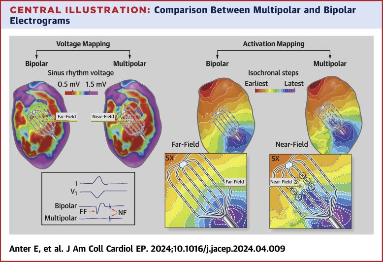 Multipolar Electrograms: A New Configuration That Increases the Measur... sciencedirect.com/science/articl…