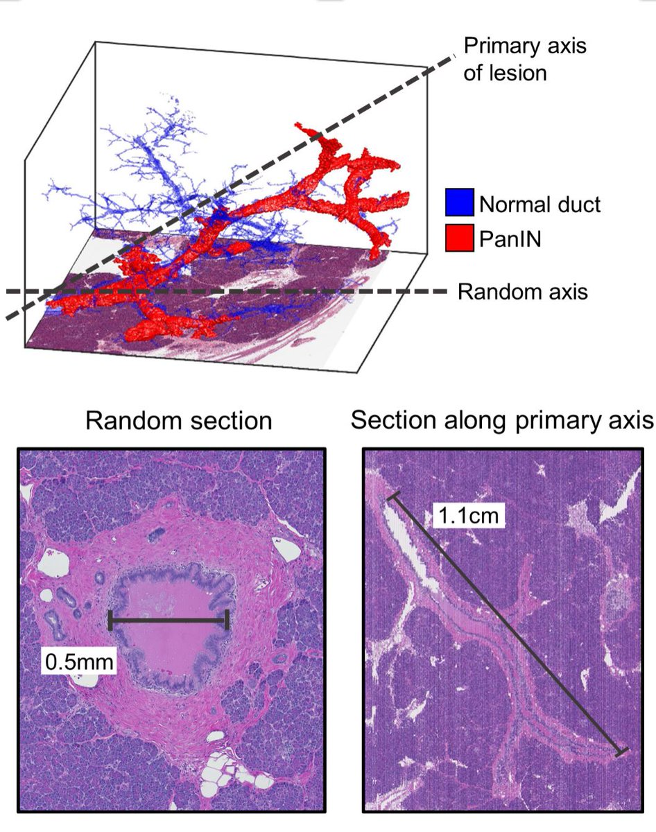 Another paper out today in the American Journal of Surgical Pathology! Recently, we’ve shown that PanIN are more abundant and genetically diverse than previously thought. Here, we expand on this to show that 3D imaging challenges the 2D classification criteria of PanINs.