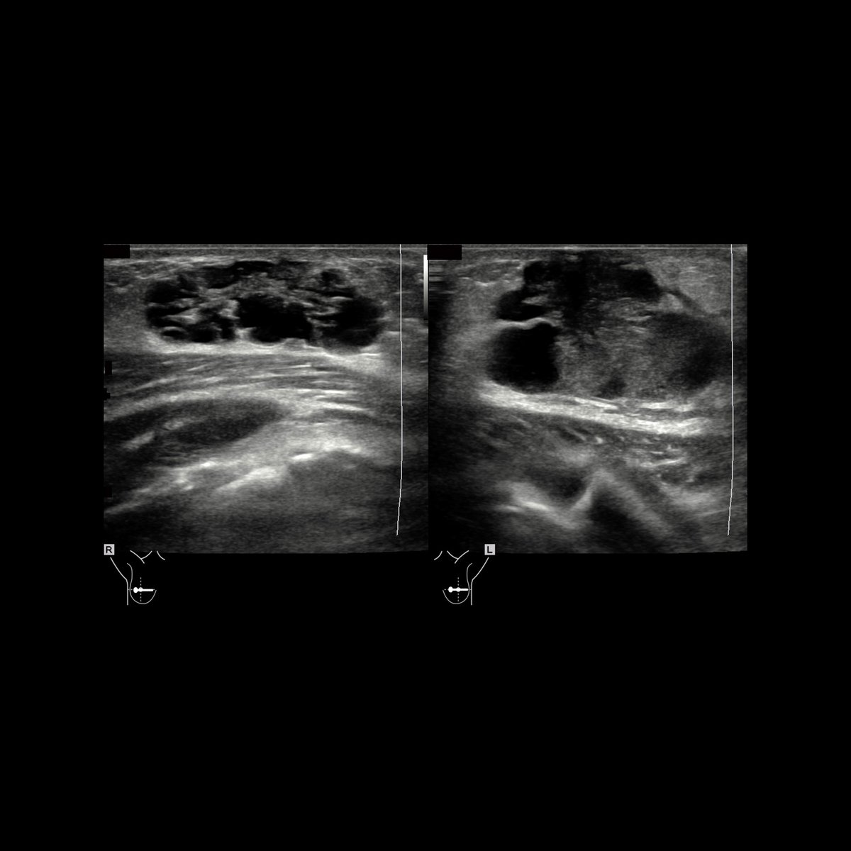 Female infant with left breast swelling

Transverse US of retroaerolar regions of right breast(left)+left breast(right) show mild bilateral skin thickening with bilateral diffusely hyperechoic breast tissue containing multiple anechoic lesions.

#FOAMed #MedEd #FOAMRad #PedsRad