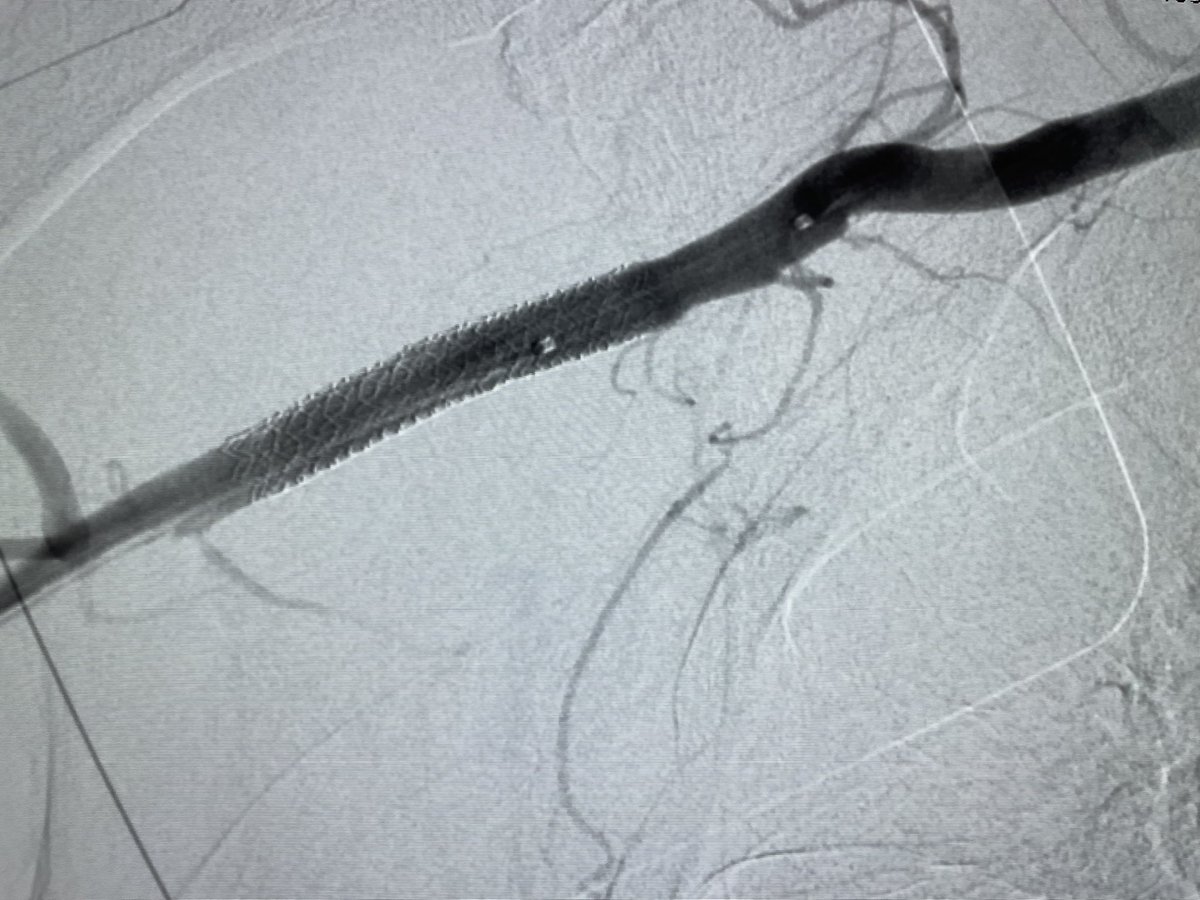 73y man, DM2, severe PVD admitted w/ decomp HF. Cardiac MR with EF:30%, large antero-lat ischemia and inf fibrosis. CAG: RCA CTO, calcified nodule LM and severe IRS ostial LAD+CX. @ProtectedPCI w/ Impella CP via right axilar art. IVL LM + LM/LAD stent + KB + POT + DEB ostial CX