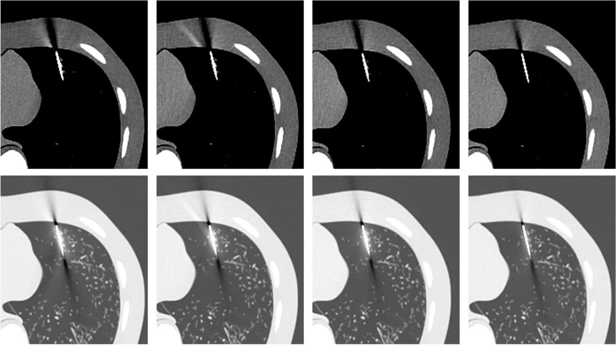 New study in #BMCBiomedEng shows 0.5 mm silver filter reduces needle artifacts in CT-guided biopsies leading to better depiction of the target and surrounding structures without compromising image quality. To discover more, please visit: go.sn.pub/rk4mtp