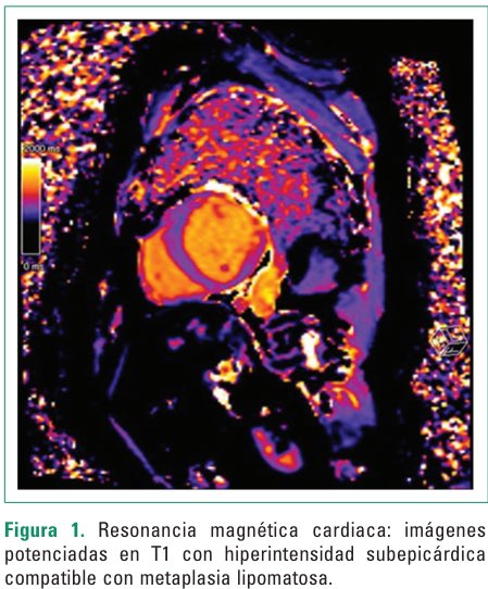 #RIAC - Metaplasia lipotamosa: una entidad poco reconocida del infarto de miocardio
✍🏽Caso clínico del Dr. Lenin Tumbaco y cols. 🇦🇷
en la Revista Interamericana de Cardiología

Recuerda¡¡ Puedes enviar tu trabajo científico a RIAC💪🏼

 revistainteramericanacardiologia.com/inpress.php