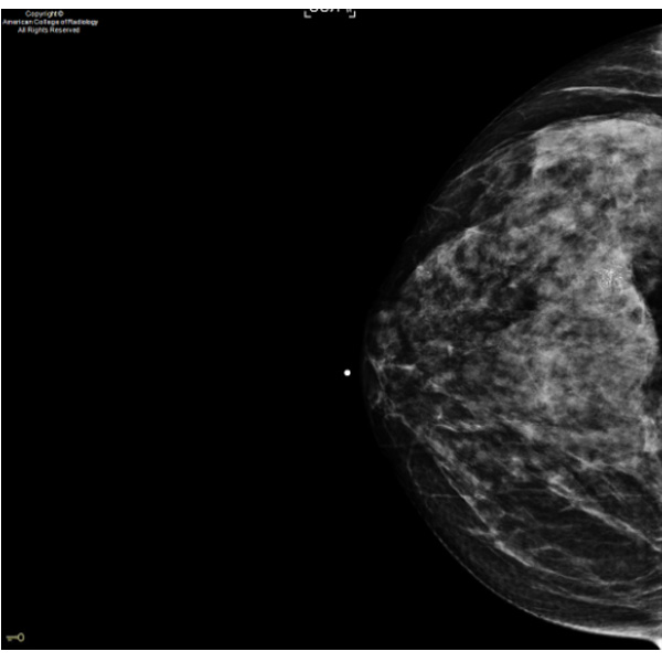 A 54-year-old woman presents for a screening mammogram. #ACRCaseinPoint bit.ly/3JzageH