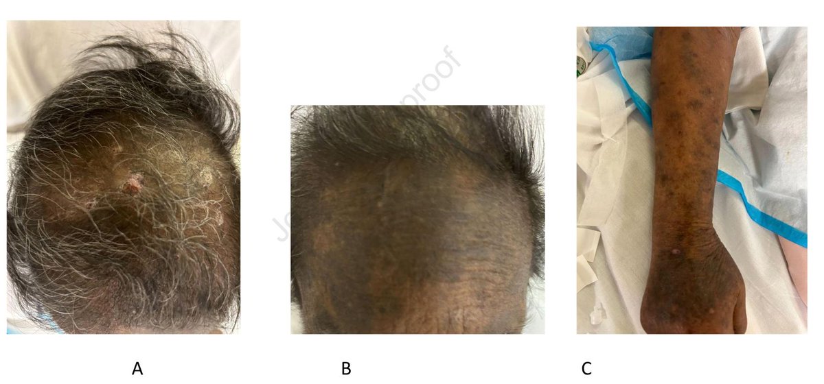 IMAGES IN KIDNEY MEDICINE Dialysis Patient With a Unique Rash buff.ly/4dPNM7p