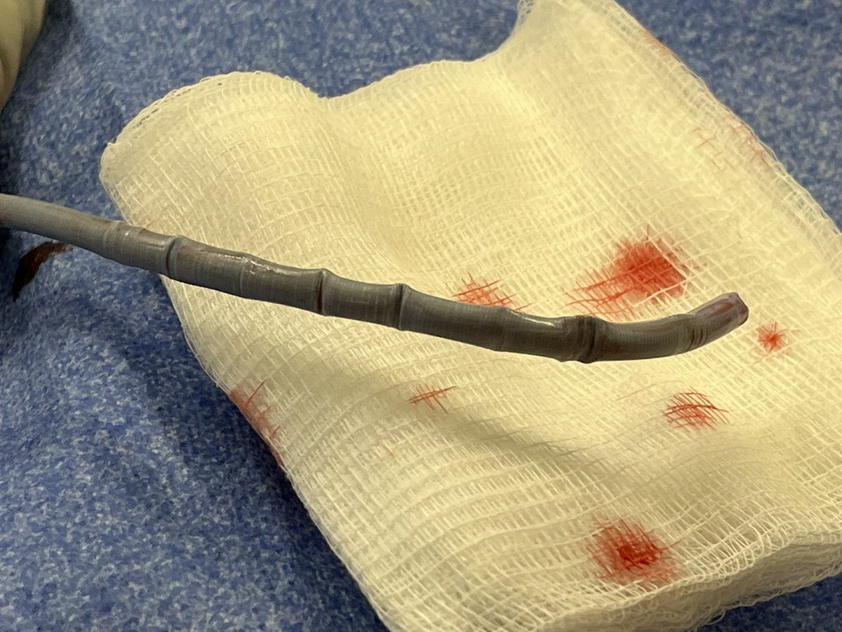 Ipsilateral IBE from single groin access under local for rupture AAA from type 1b endoleak from previous EVAR. The 12F dry seal sheath makes that hair pin turn somehow and allows for delivery of the internal iliac stent; but wow the sheath gets beat up. Patient did well!