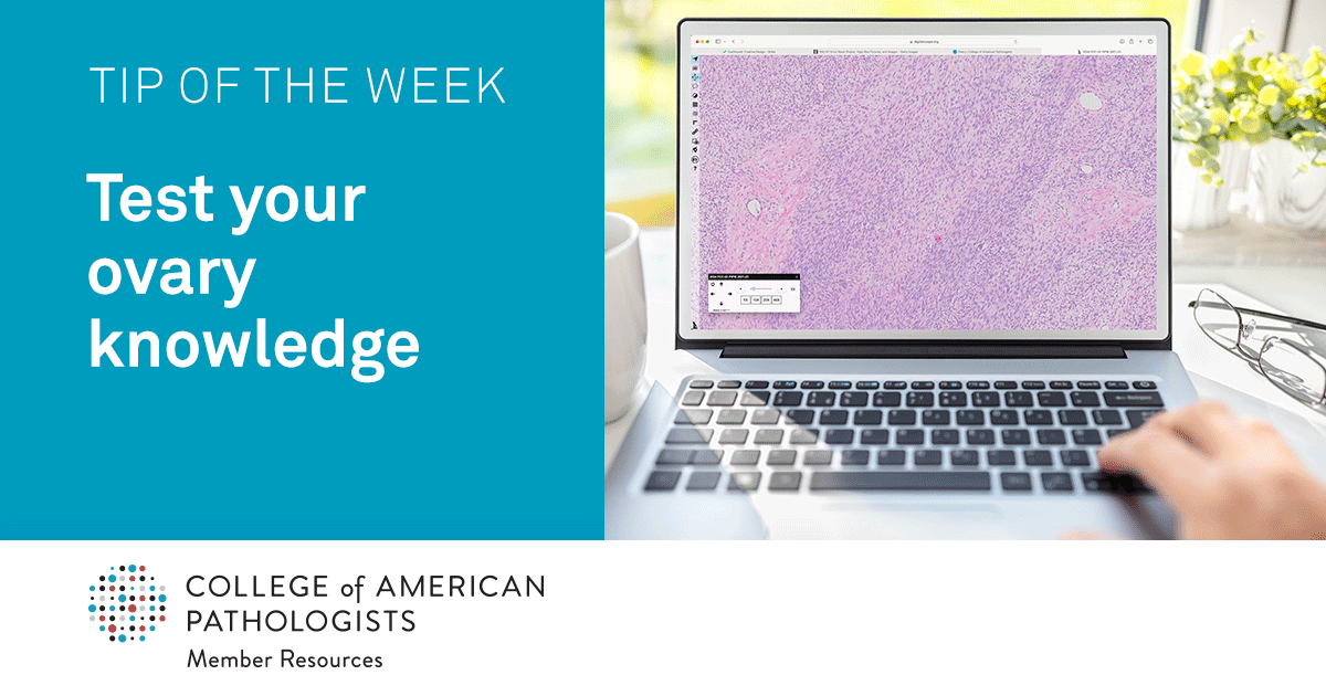 #TipoftheWeek: Test your ovary knowledge. Keep your skills sharp and check what you know about diagnosis of the ovary using a digital image and reading more about the case of the month. brnw.ch/21wJX4S