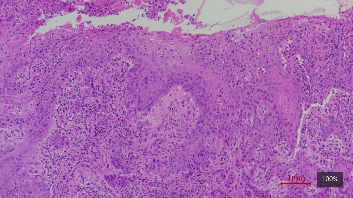 lorenaevilla's tweet photo. Anal ulcer and cellular changes consistent with herpes infection  #pathoupic  #pathAward  #GIpath  #pathology  #pathologist https://t.co/KsTUGiUKRd