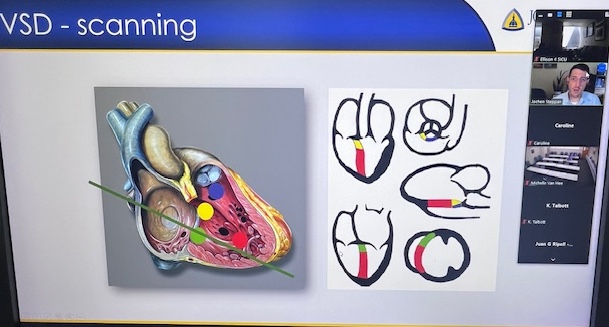 TenzingMD's tweet photo. How to think about periop care of adult congenital heart diseases -echo findings and hemodynamic considerations w/expert @JSteppan for MGH-Mayo crit care echo lecture series! #echofirst #POCUS #FOAMed #FOAMcc #Medtwitter https://t.co/WM67eHFiOk