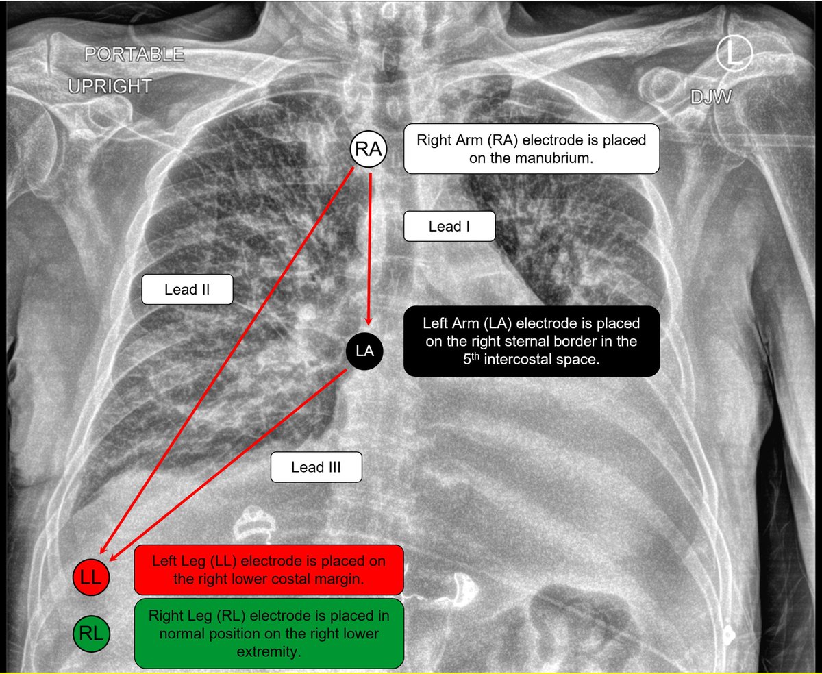 Have you ever used the modified Lewis lead configuration to identify atrial activity? An easy and useful tool which is probably not in everyone's toolbox. Check out our case in @CircAHA @VCUHealthHeart #ACCFIT #EPeeps Pursuing P Waves | Circulation (ahajournals.org)