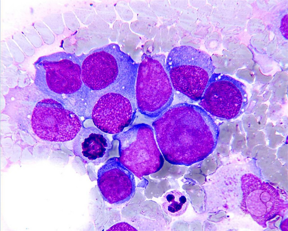 plasmablastic lymphoma | ASH Image Bank | American Society of Hematology imagebank.hematology.org/image/6377/pla… #ASHImageBank