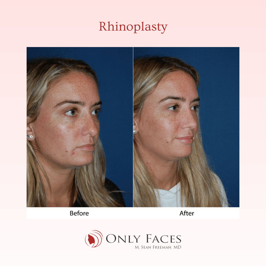 OnlyFacesCLT's tweet photo. This 28-year-old is three months post-op from a #Rhinoplasty with Dr. Sean Freeman. #OnlyFaces #NoseJob https://t.co/FUhrn6o2Q2