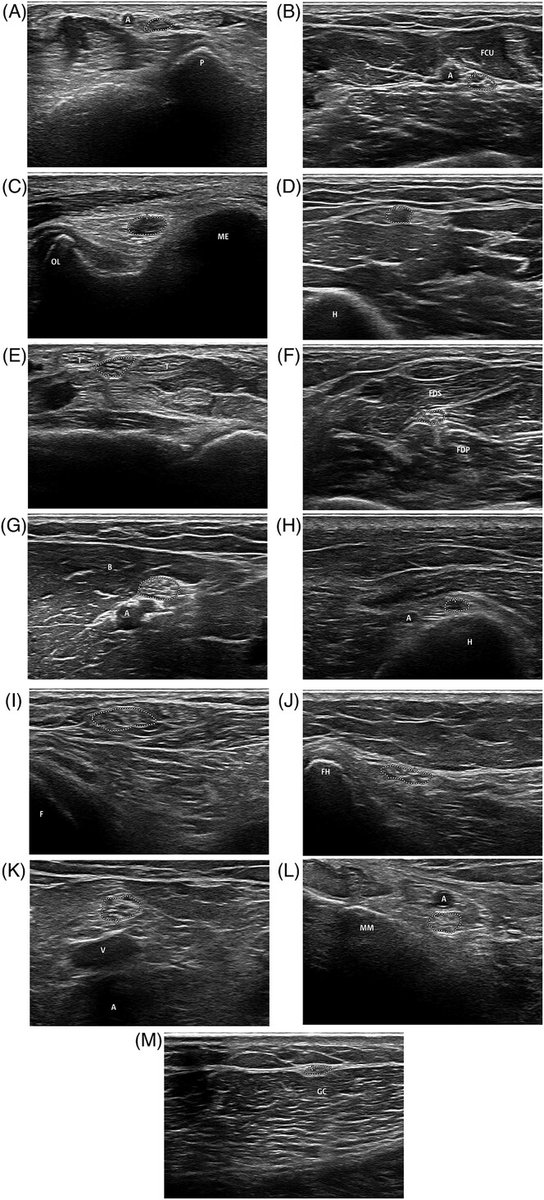 Nerve cross-sectional area in advanced uremic neuropathy: A nerve ultrasound pilot study. onlinelibrary.wiley.com/doi/full/10.11… #neuroimaging #neurology #neurotwitter #neuroscience #neurorad #radres @WileyNeurology @asneuroimaging #neuropathy #nerveultrasound This article is free to read