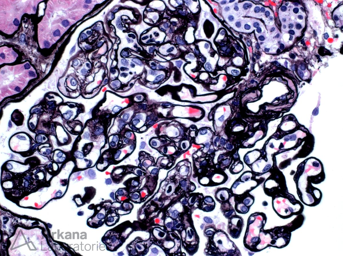 arkanalabs's tweet image. What is your diagnosis in this renal transplant patient? #DiagnoseThis #RenalPath