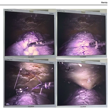 julianvarascom's tweet image. WHAAAAT? THIS IS NOT REAL? 
#simulation #thisistheway #advancedtraining #nomorebasicstuff
Video in the first comment + DOI
@AmericanHernia @eurohernias @BritishHernia @RicardoRGlz @me4_so @SimulacionUC @UCSFSkillsLab @HPB_Surgeon @gaboescvi