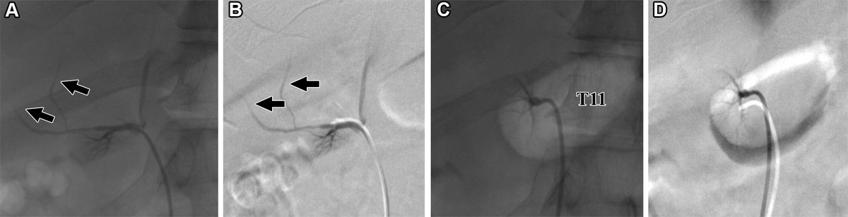 Thorough knowledge of adrenal vein anatomy, technical tips for adrenal vein cannulation, and the use of adjunctive techniques can aid those performing adrenal vein sampling. bit.ly/3WIiusP @upstaterad